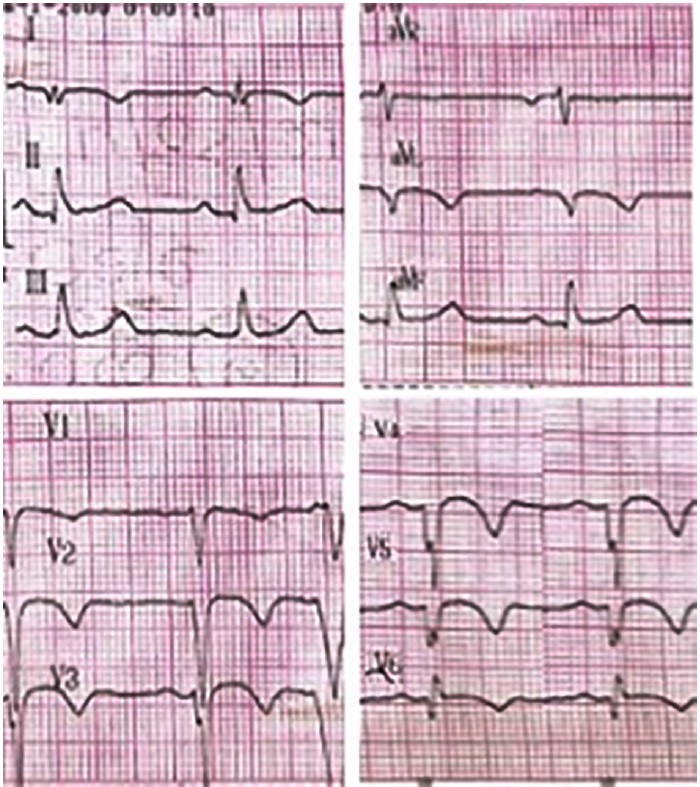 Electrocardiograma posterior a la cardioversion