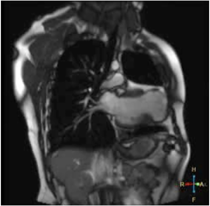 Taquicardia Ventricular monomorfa