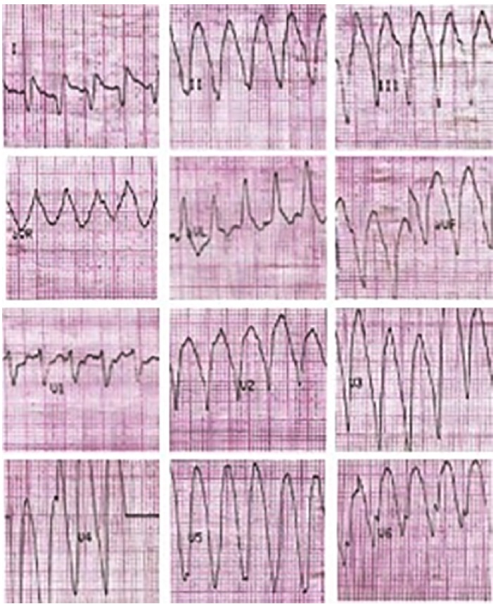 Taquicardia Ventricular monomorfa