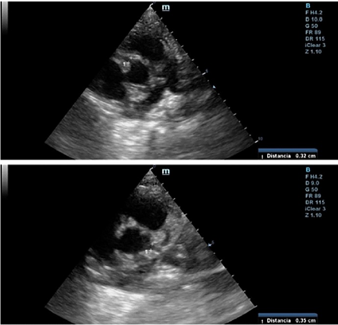 Ecografía Doppler 2D